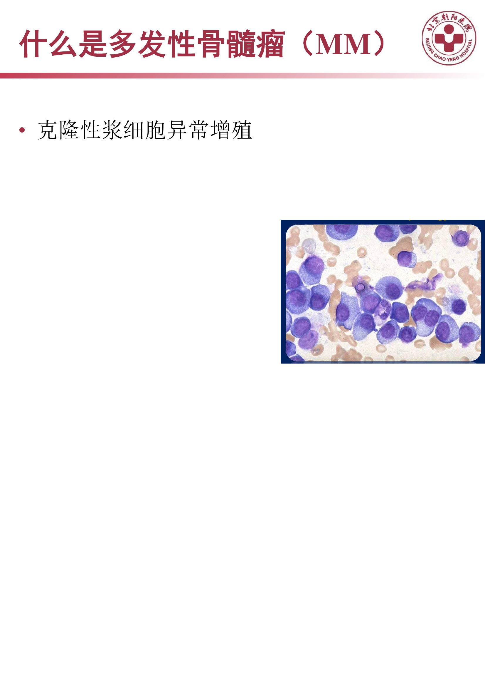 多发性骨髓瘤的诊治策略 3.jpeg