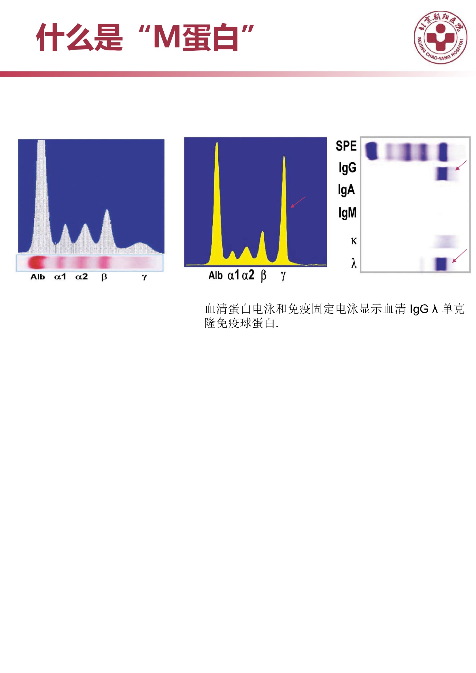 多发性骨髓瘤的诊治策略 6.jpeg