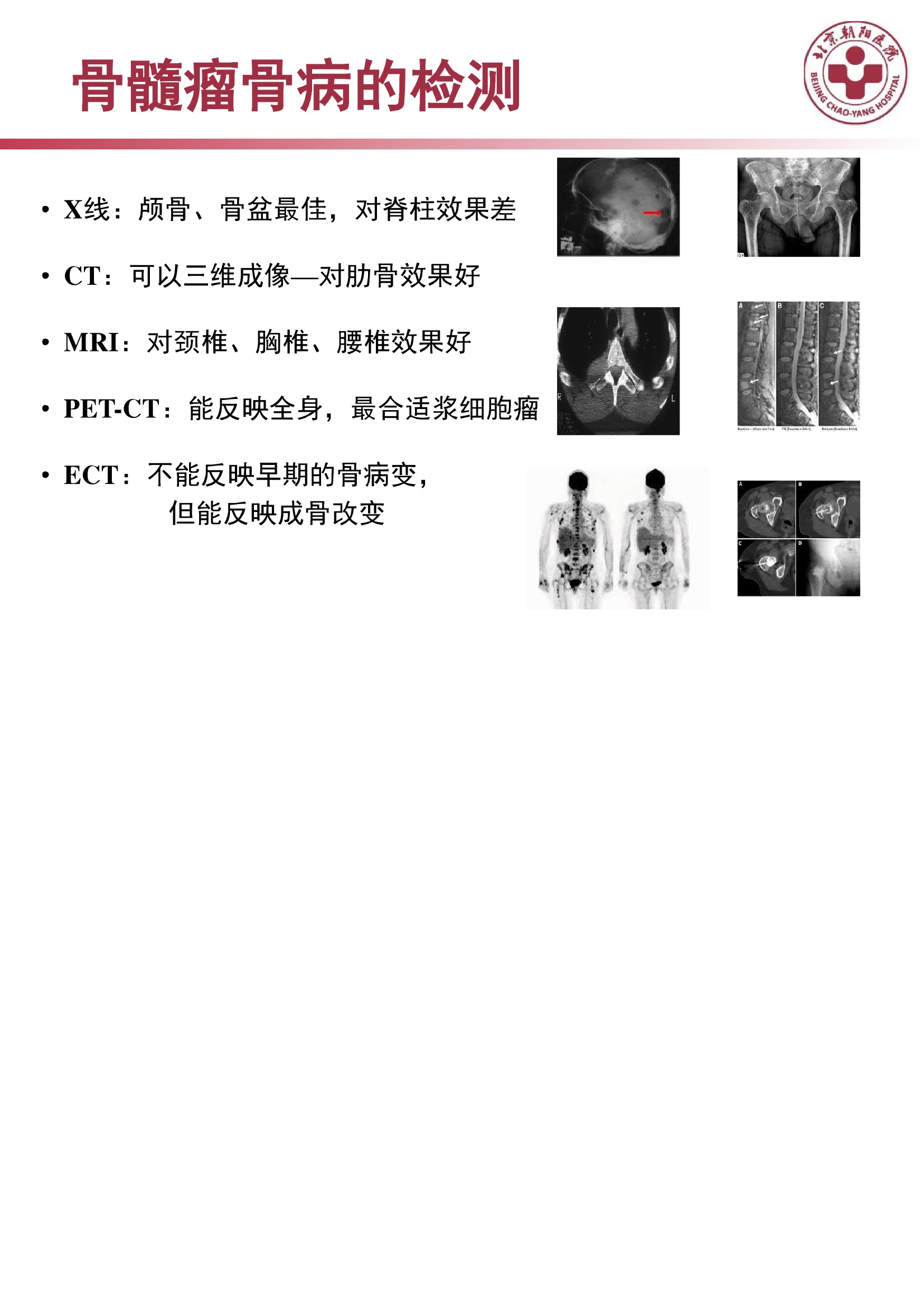 多发性骨髓瘤的诊治策略 12.jpeg