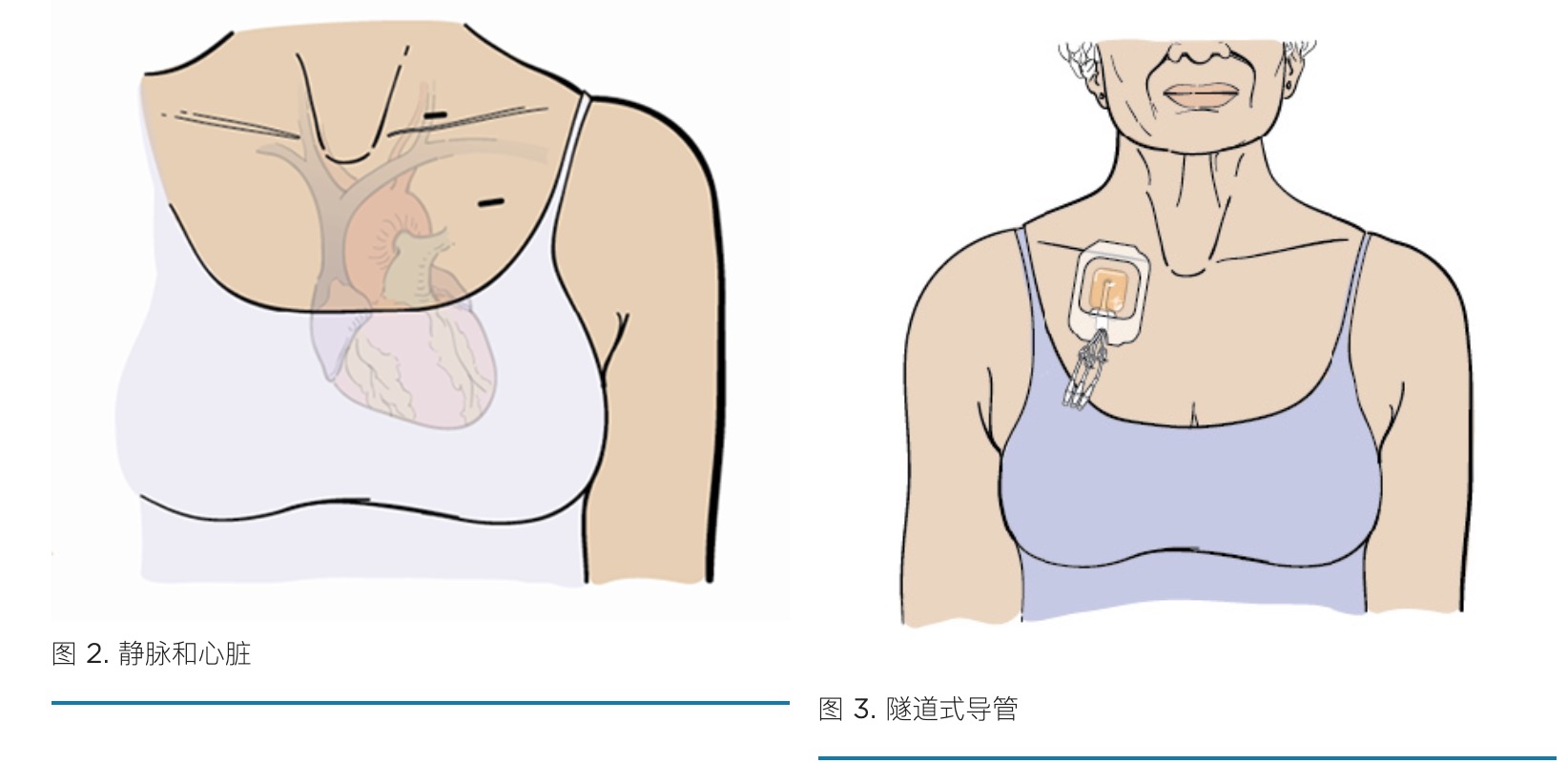 CVC置管.png
