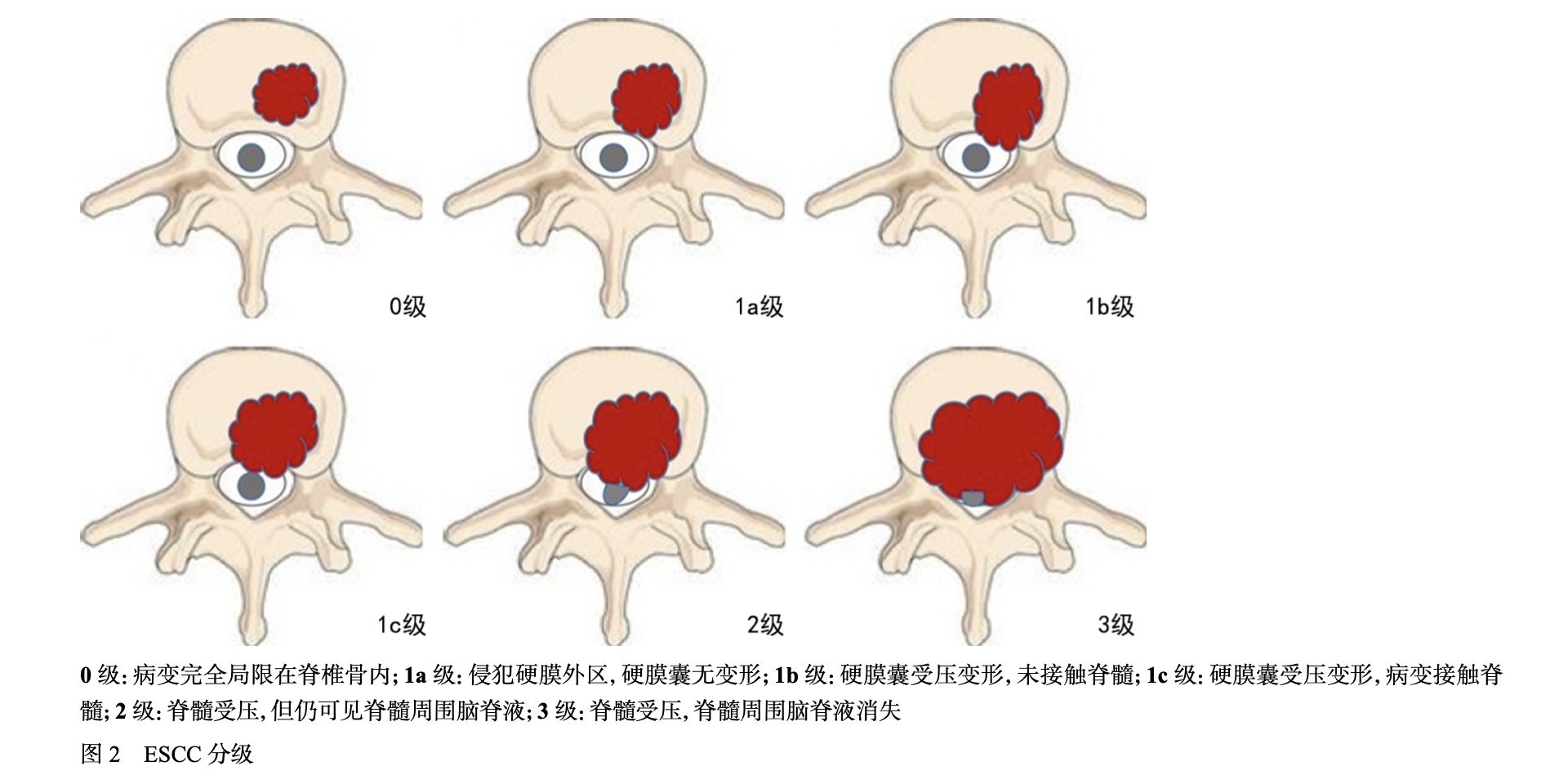 ESCC分级.png